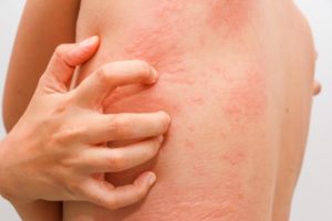 allergies of the skin
