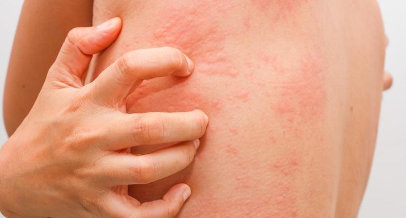 allergies of the skin