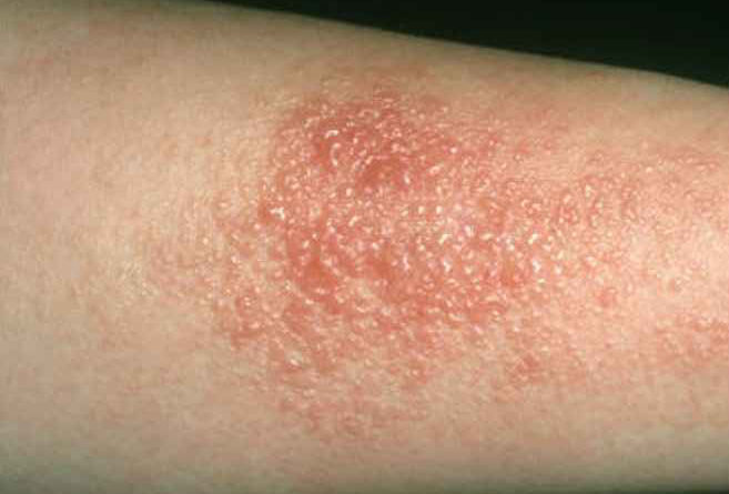 contact dermatitis rash allergies denton