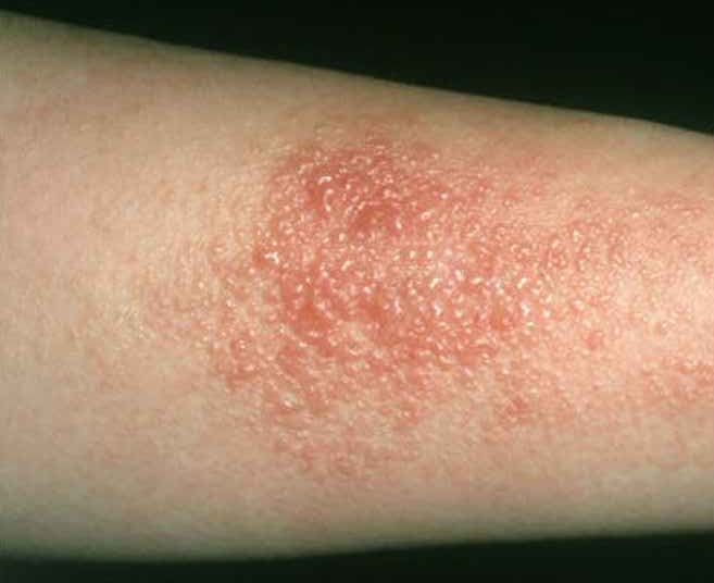allergic contact dermatitis)