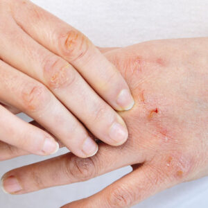 Eczema Allergist - Denton