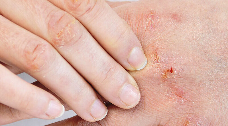 Eczema Allergist - Denton