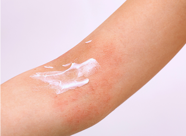 eczema allergies denton